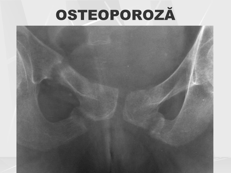 OSTEOPOROZĂ